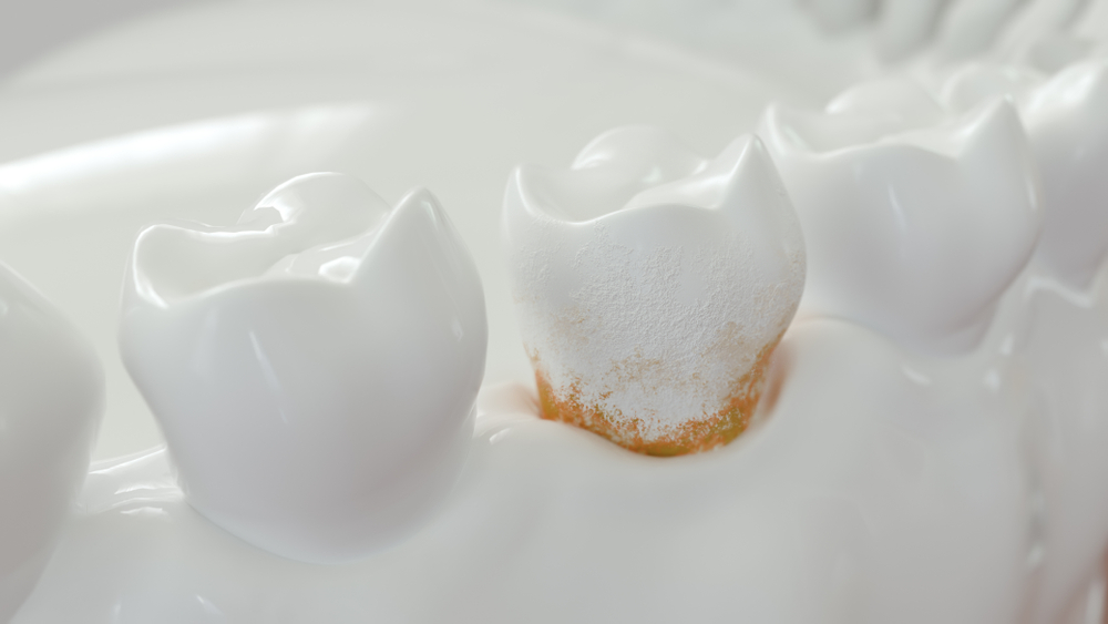 What Is Dental Plaque? Boyett Family Dentistry Winter Haven, FL